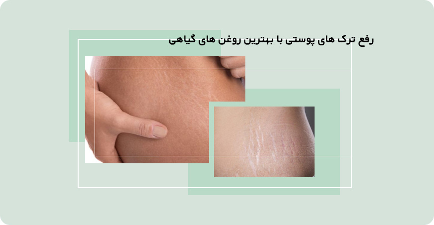رفع ترک های پوستی با بهترین روغن های گیاهی